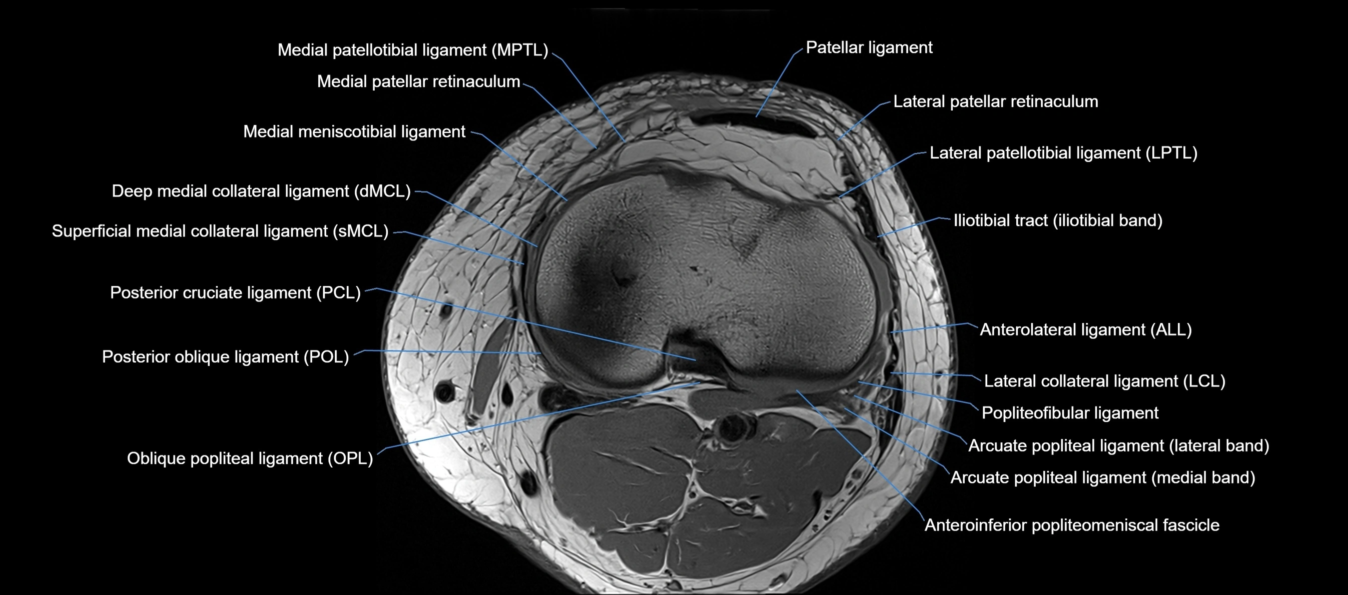 MRI Knee axial  ligaments cross sectional anatomy 3T  radiology  image-img-03001-00032.webp